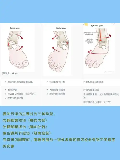 不同级别的踝关节内翻扭伤预计康复时间和要求如下:1 级一1