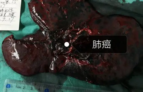 吸烟35年的肺是这样的! - 好大夫在线