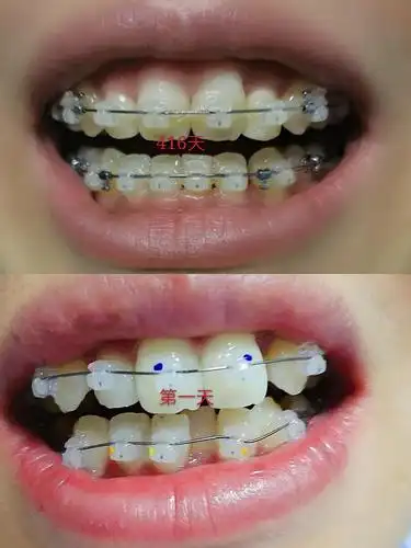 牙齿矫正历程交流贴附图慎点