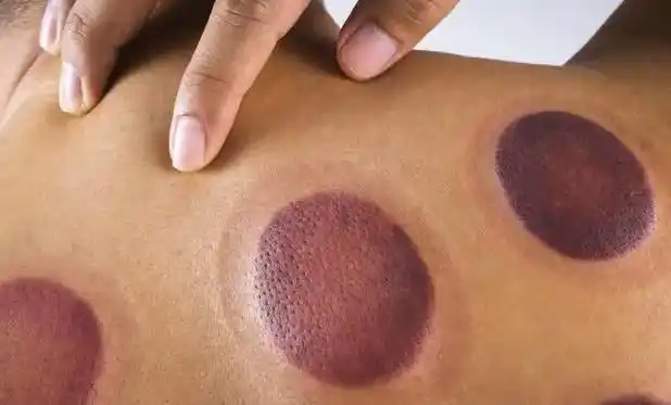 听听医生怎么说|拔罐|穴位|淤血_网易订阅