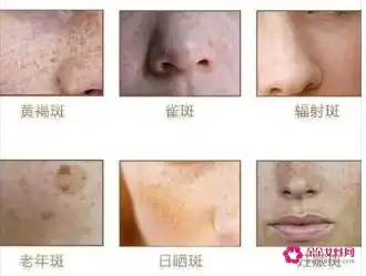 1,黄褐斑雀斑和日晒斑的区别 黄褐斑也称肝斑,为面部的黄褐色色素沉着