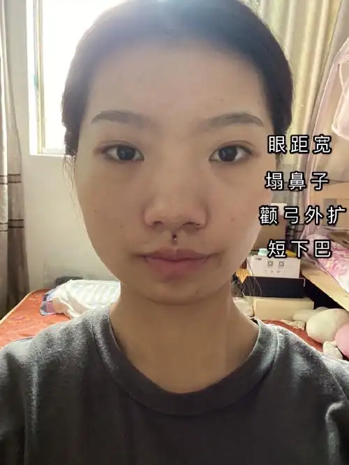 又是一个宽眼距的妹子,同样也有颧骨的问题,不过这位_圈子-新氧美容整
