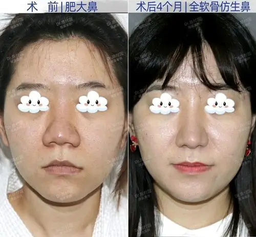 术前难点清晰可见:鼻头肥大,鼻翼外扩,皮肤厚,肤质_圈子-新氧美容整形