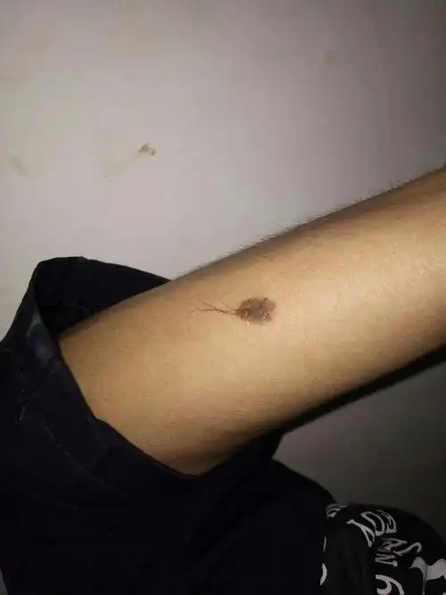 看了网上说的恶性痣很可怕,想知道我的这个痣应不应该去除.