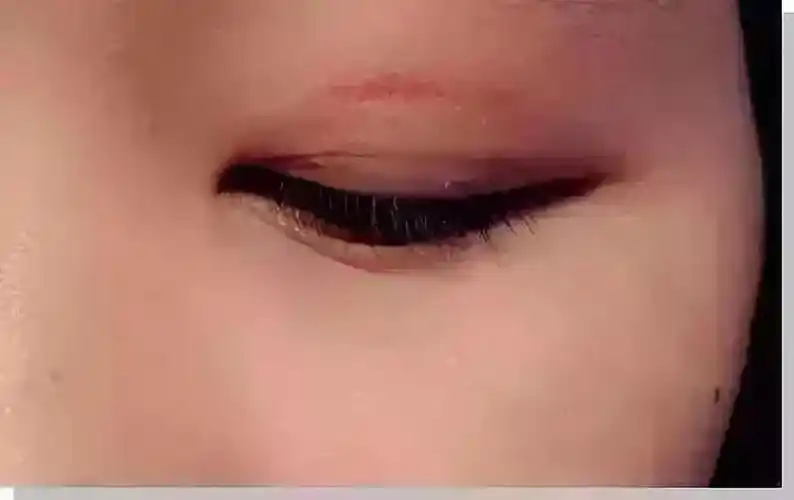 使用双眼皮贴 美是美了 但是长久下来 她的眼皮严重下垂 还有很多折痕