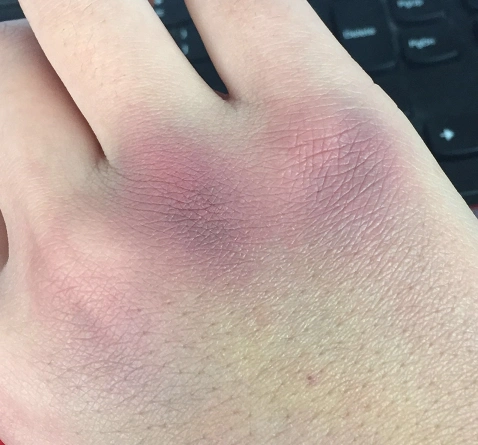 打完点滴两天后手背,拳头处出现淤青,也不疼