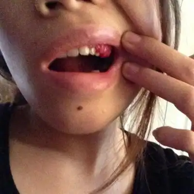 牙龈肿成了一坨坨的肉了怎麼办?能好吗?