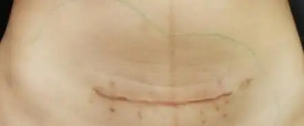 竖着的剖腹疤痕产后疤痕分横着的和竖着的.