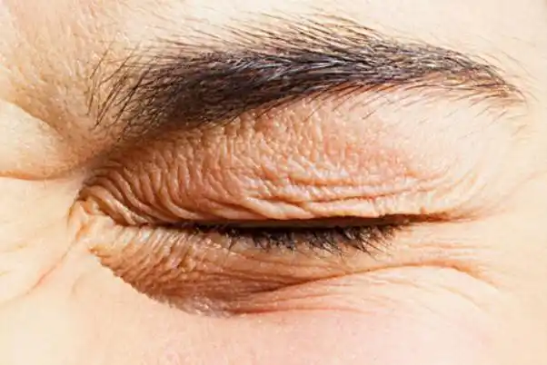 眼部细纹可以热敷吗眼部细纹能淡化吗