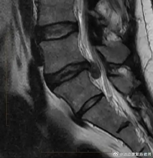 腰椎间盘突出#一篇文章,带你分清什么是腰椎间盘膨出,突出和脱痴忖