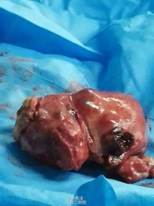 罕见良性子宫肿瘤梭形细胞瘤