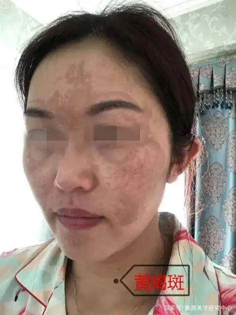 点进来告诉你:你长的是什么斑!