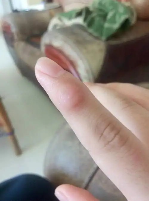 手上长了一个硬硬的东西,可以剪,但剪了还会长,一压就痛.