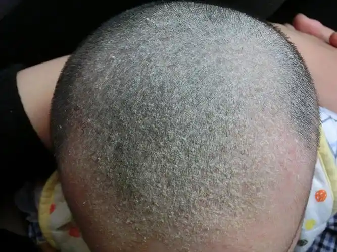 两个多月的婴儿头上有很多像头皮屑样的东西,有的说不管,大了就没了