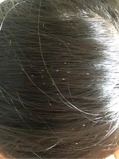 头发上有白色管状物附着疑似剪发虫