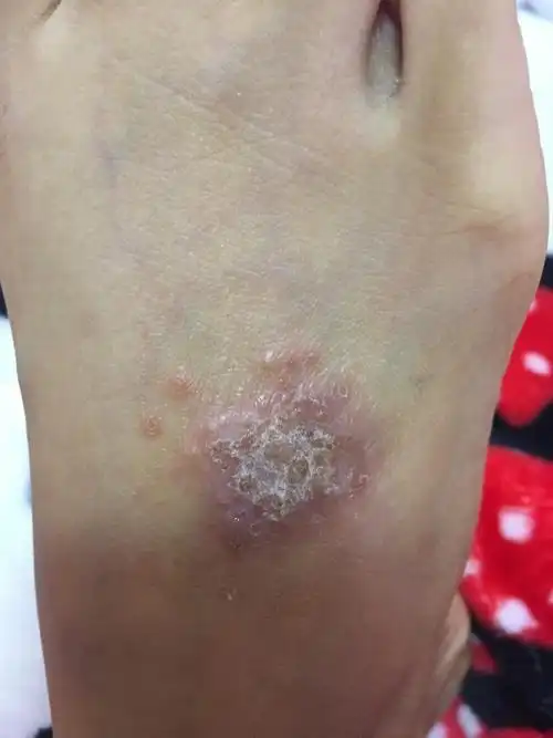 请问我这种是湿疹还是什么? 特别痒. 还有水泡. 一直不好