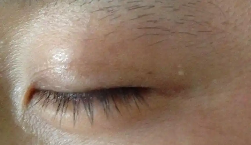 外眼角眼皮发了一粒白色的东西,不知道是什么.有图.