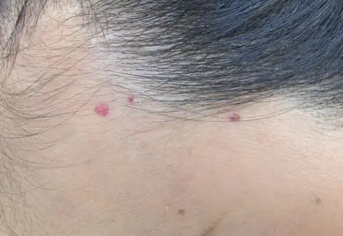 带您了解老年性血管瘤(身上的小红点)