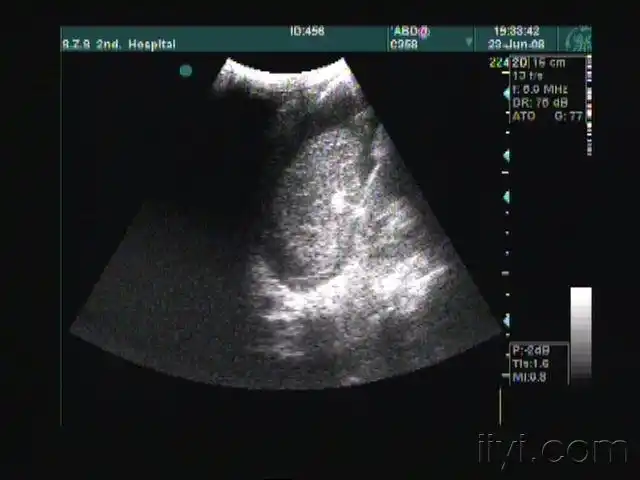 脾破裂图像收集 - 超声医学讨论版 - 爱爱医医学论坛 - 爱爱医医学网
