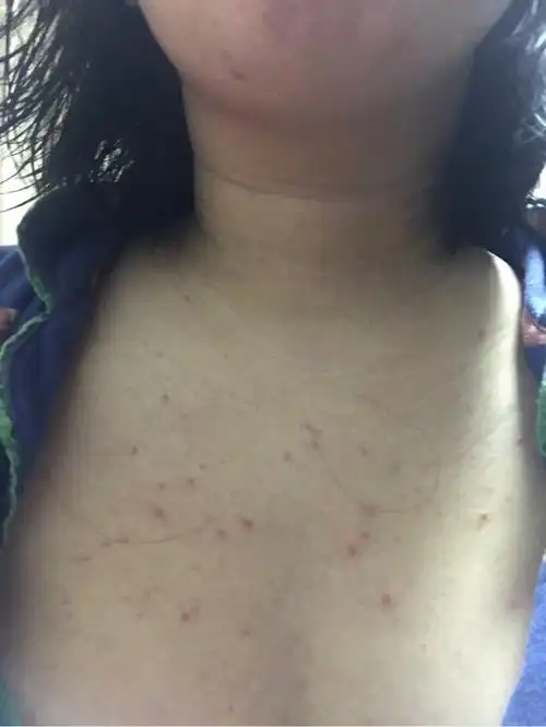 胸前长痘痘怎么治疗 胸前长痘痘怎么治疗最有效