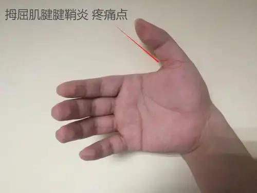 可能也带来了隐患——"桡骨茎突狭窄性腱鞘炎","拇屈肌腱腱鞘炎"