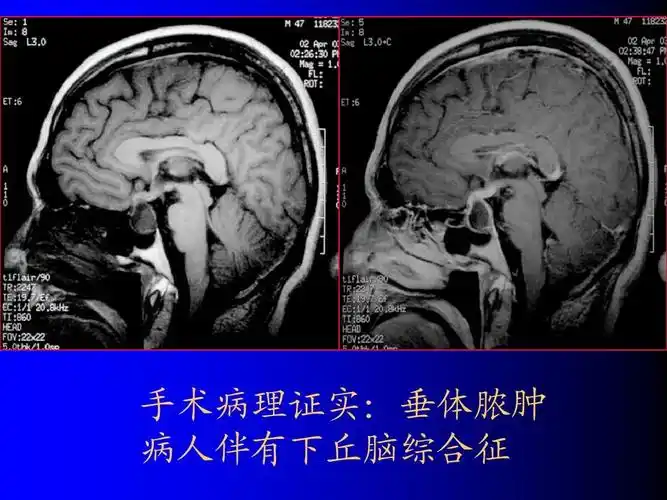 磁共振成像诊断修后 (mri)3ppt