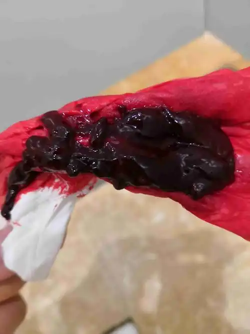 小腿肌肉疼痛,胸部胀痛,姨妈第三天第四天是大块肉一样的血块,是怎么