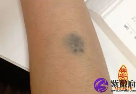 胳膊胎记的位置与命运-紫微府