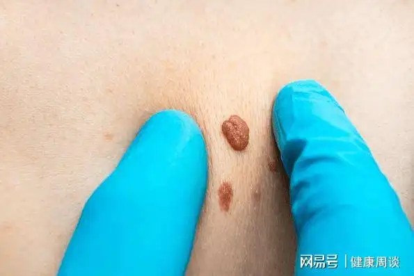 但是,如果是存在腹部肌肉内的硬性纤维瘤,其具有一定恶变的可能,应当