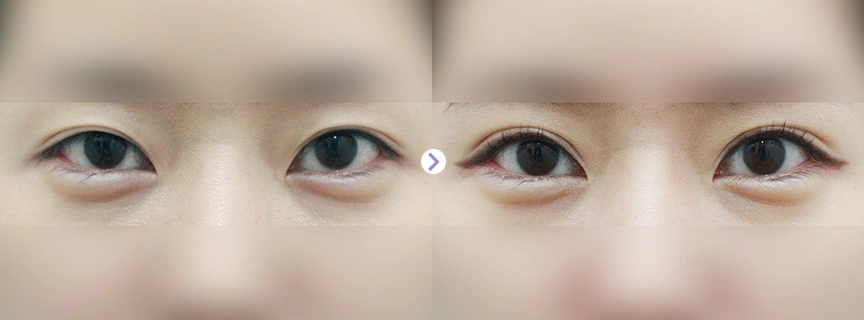 韩国加美朴建昱做surppise眼部整形效果如何