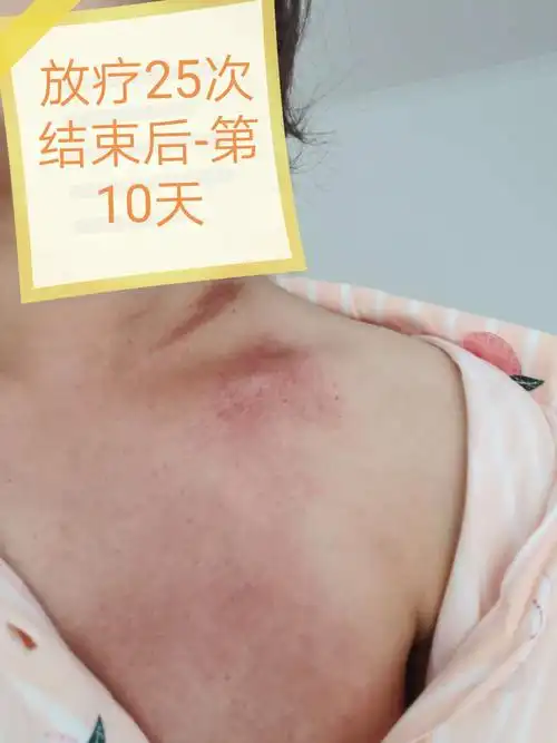 放疗25次过程记录