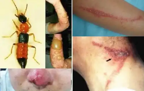 隐翅虫咬人后图片身上有毒素慎手拍教你怎么办