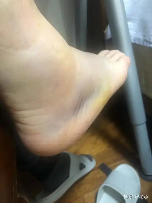 右脚崴脚(有骨折)的健身之路 - 知乎