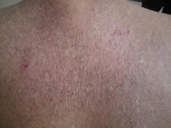 皮肤淀粉样变一例.