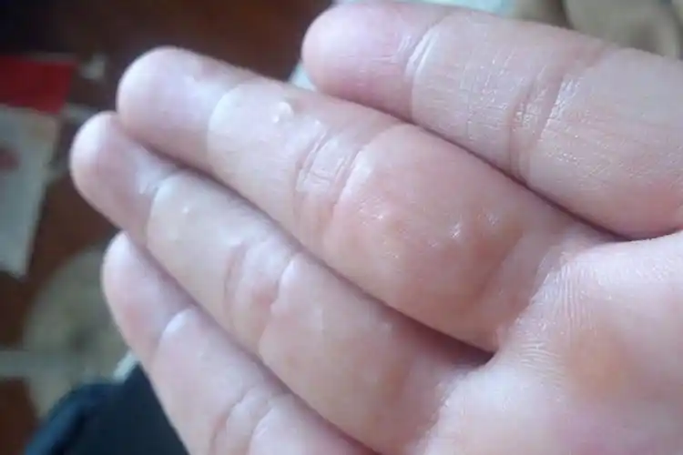 手掌心湿疹图片