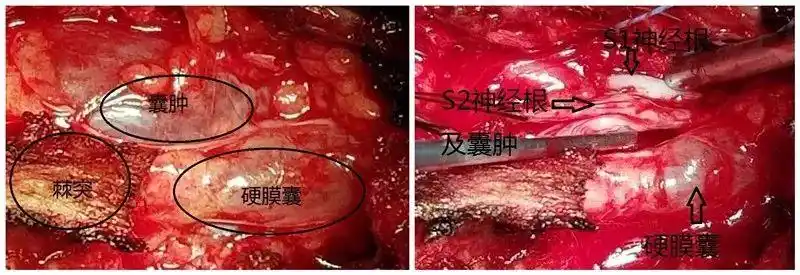 脊柱外科医生教您认识骶管囊肿