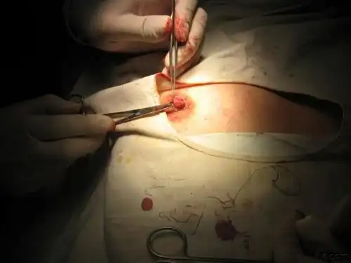 12:10:29该手术是在我院进行的第一例"乳头凹陷矫正术",适合乳头凹陷