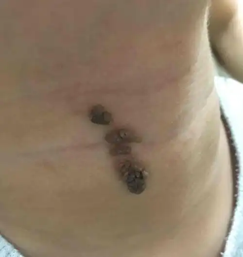 疣状表皮痣