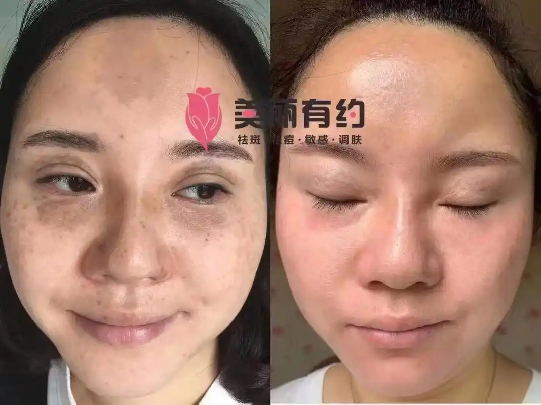 早安[玫瑰] 额头上印堂发黑也叫孝斑,也是好多店家头疼的事, - 抖音