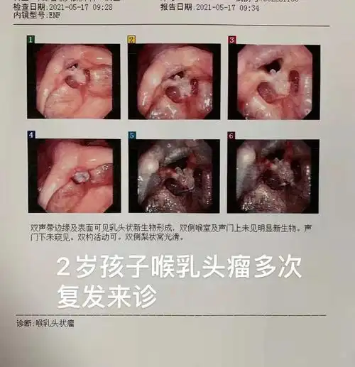 喉乳头状瘤的综合诊疗方案手术