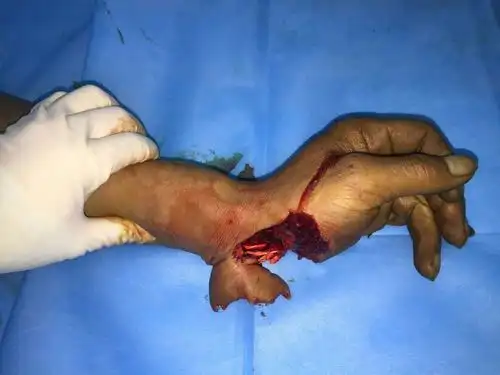 手外创伤伤类病人