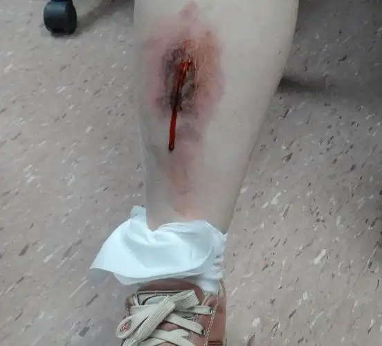 医:深色疤痕的真相是.