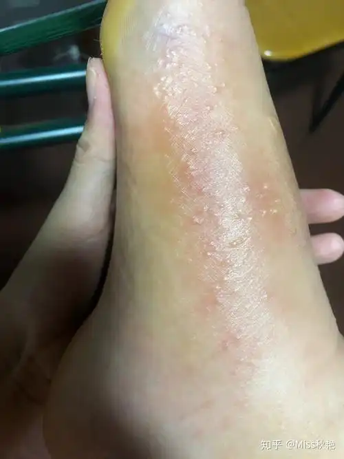 皮肤过敏起水泡怎么办? - 知乎