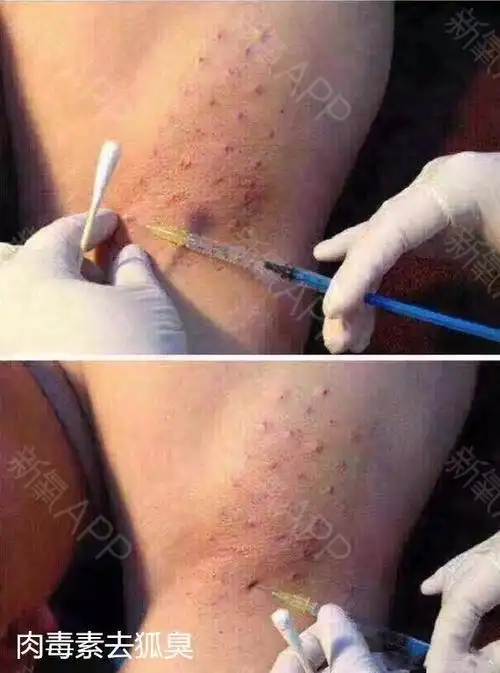 激光除腋臭好不好_效果图_昆明bbh日韩系激光除腋臭术后第0天_新氧