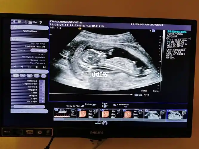 nt秒过 姐妹们来接 顺便帮我看看男女_nt检查_二胎_怀孕_母婴_孕产