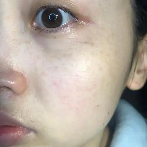 黄褐斑和雀斑是一种吗,黄褐斑和雀斑是一种吗图片