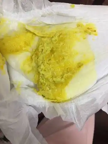 今天发现宝宝拉的便便是这样子的,是消化不良吗?