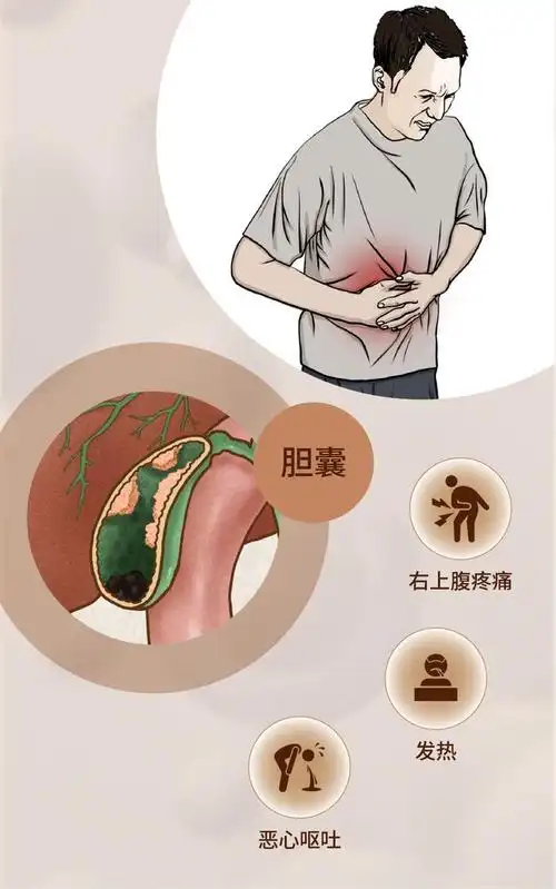 科普|急性胆囊炎怎么治,如何防?