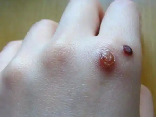 身上长的瘊子,分公母吗?_手机搜狐网