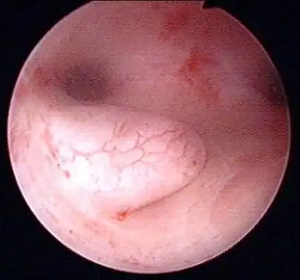 子宫内膜息肉_疾病介绍_介绍 - 好大夫在线